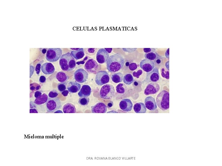 CELULAS PLASMATICAS Mieloma multiple DRA. ROXANA BLANCO VILLARTE 