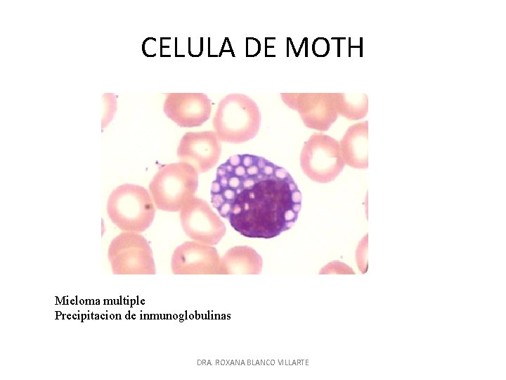 CELULA DE MOTH Mieloma multiple Precipitacion de inmunoglobulinas DRA. ROXANA BLANCO VILLARTE 