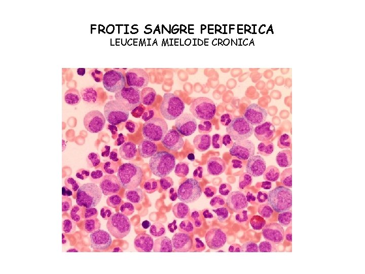 FROTIS SANGRE PERIFERICA LEUCEMIA MIELOIDE CRONICA 