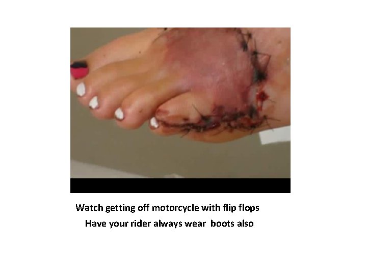 Watch getting off motorcycle with flip flops Have your rider always wear boots also