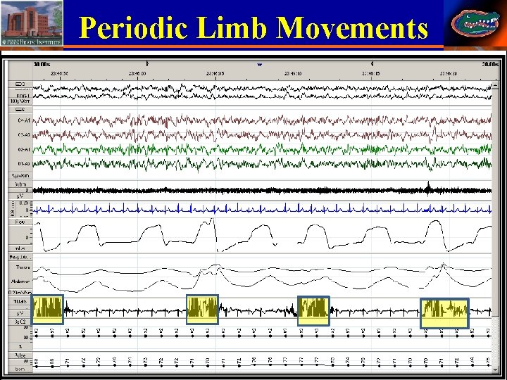 Periodic Limb Movements 38 Stephan Eisenschenk, MD Department of Neurology 