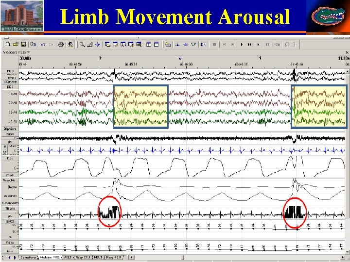 Limb Movement Arousal 40 Stephan Eisenschenk, MD Department of Neurology 