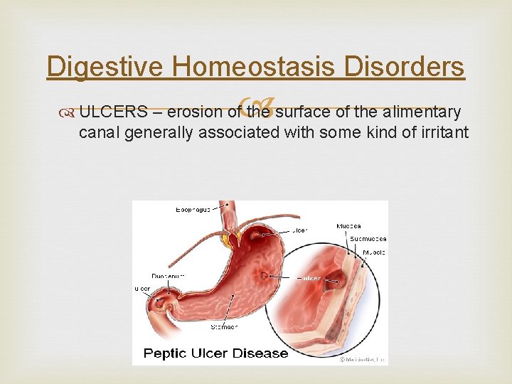 Digestive Homeostasis Disorders ULCERS – erosion of the surface of the alimentary canal generally