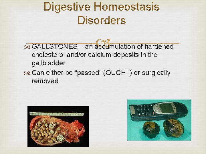 Digestive Homeostasis Disorders GALLSTONES – an accumulation of hardened cholesterol and/or calcium deposits in