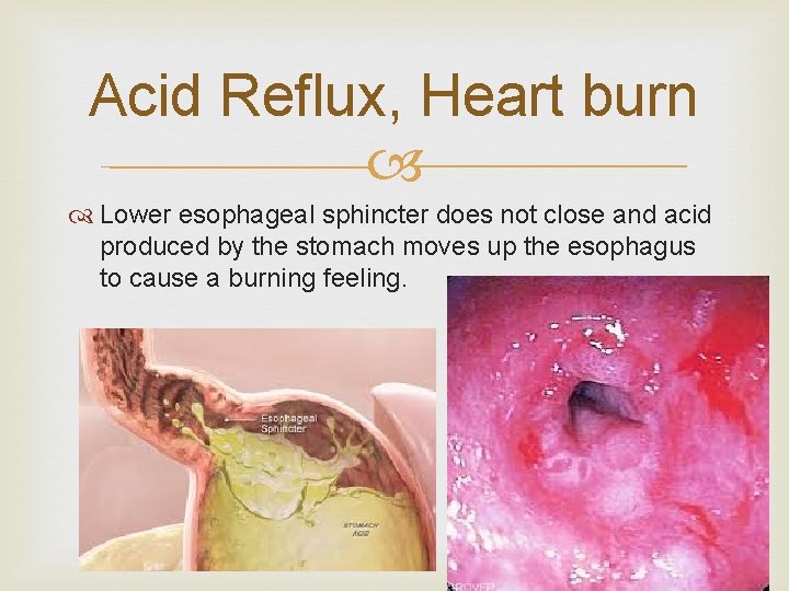 Acid Reflux, Heart burn Lower esophageal sphincter does not close and acid produced by