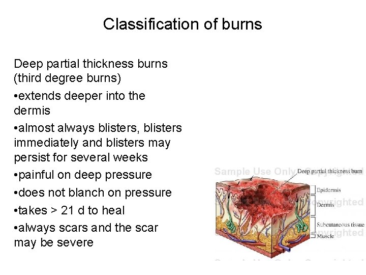 Classification of burns Deep partial thickness burns (third degree burns) • extends deeper into