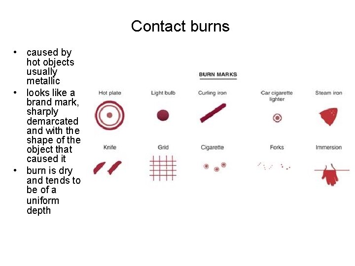 Contact burns • caused by hot objects usually metallic • looks like a brand