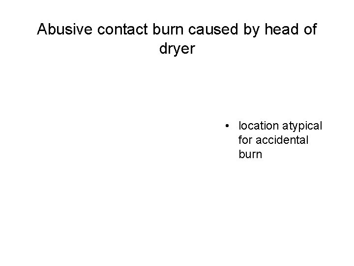 Abusive contact burn caused by head of dryer • location atypical for accidental burn