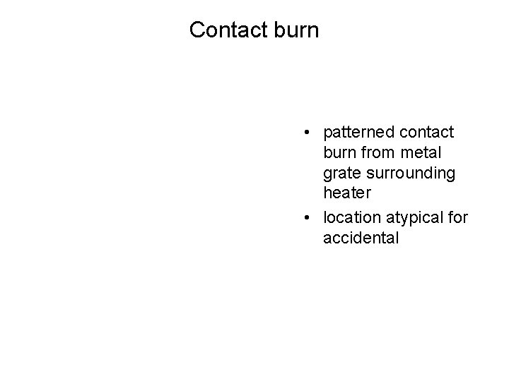 Contact burn • patterned contact burn from metal grate surrounding heater • location atypical