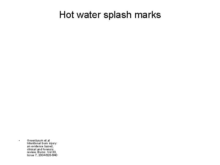 Hot water splash marks • Greenbaum et al Intentional burn injury: an evidence based,
