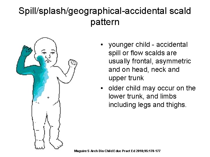 Spill/splash/geographical-accidental scald pattern • younger child - accidental spill or flow scalds are usually