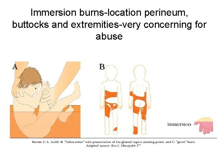 Immersion burns-location perineum, buttocks and extremities-very concerning for abuse Immersion burns 
