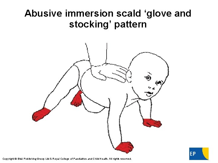 Abusive immersion scald ‘glove and stocking’ pattern Maguire S Arch Dis Child Educ Pract