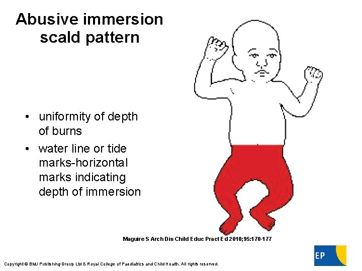 Abusive immersion scald pattern • uniformity of depth of burns • water line or