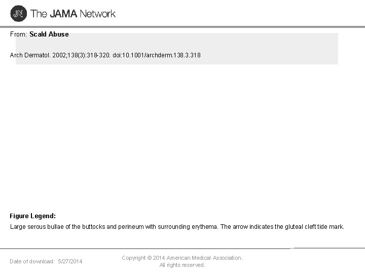 From: Scald Abuse Arch Dermatol. 2002; 138(3): 318 -320. doi: 10. 1001/archderm. 138. 3.