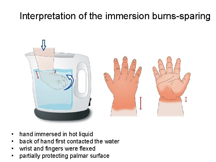 Interpretation of the immersion burns-sparing • • hand immersed in hot liquid back of