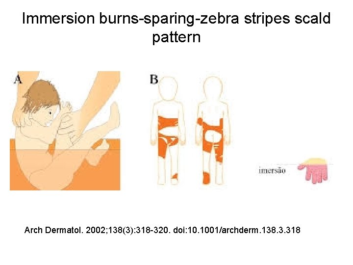 Immersion burns-sparing-zebra stripes scald pattern Arch Dermatol. 2002; 138(3): 318 -320. doi: 10. 1001/archderm.