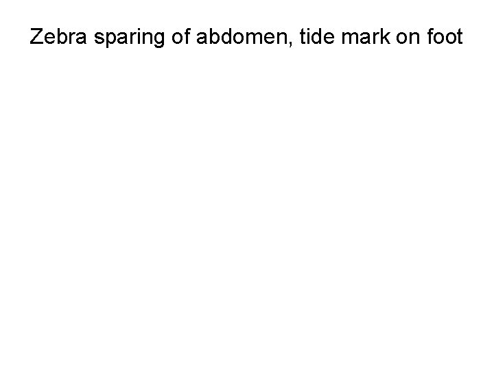 Zebra sparing of abdomen, tide mark on foot 