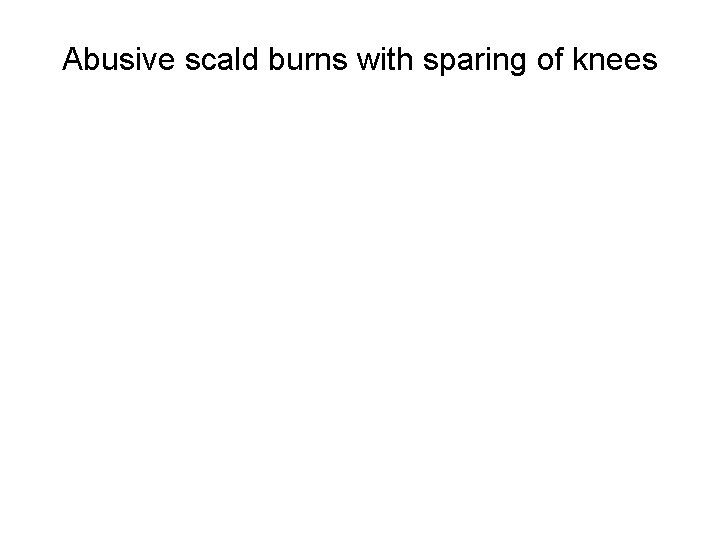 Abusive scald burns with sparing of knees 