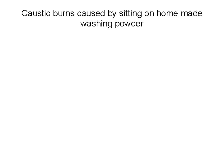 Caustic burns caused by sitting on home made washing powder 