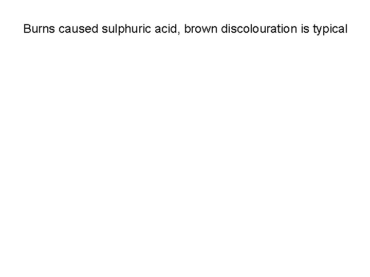 Burns caused sulphuric acid, brown discolouration is typical 
