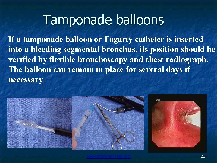 Tamponade balloons If a tamponade balloon or Fogarty catheter is inserted into a bleeding