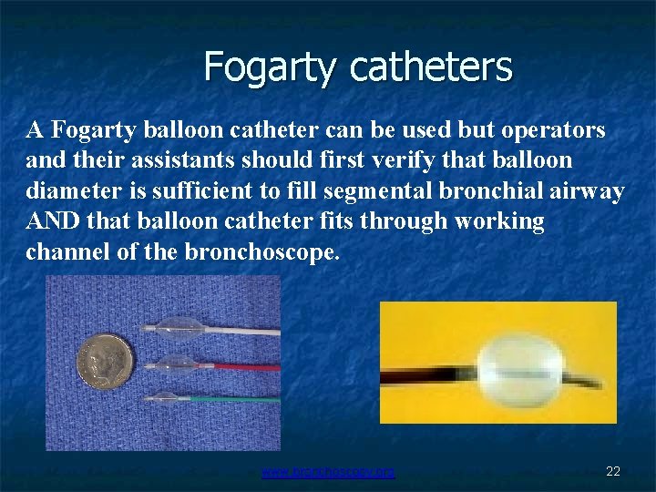 Fogarty catheters A Fogarty balloon catheter can be used but operators and their assistants