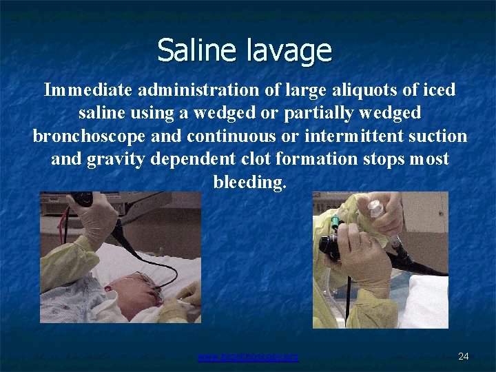 Saline lavage Immediate administration of large aliquots of iced saline using a wedged or