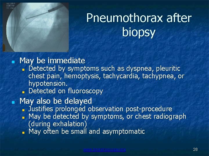 Pneumothorax after biopsy ■ May be immediate ■ ■ ■ Detected by symptoms such