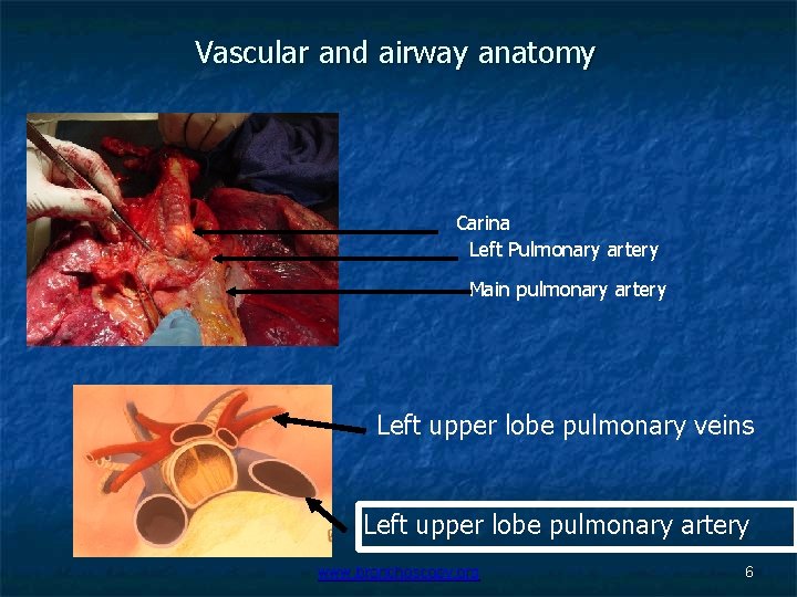 Vascular and airway anatomy Carina Left Pulmonary artery Main pulmonary artery Left upper lobe