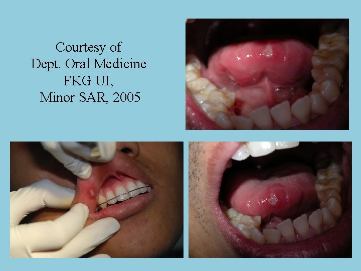 Courtesy of Dept. Oral Medicine FKG UI, Minor SAR, 2005 