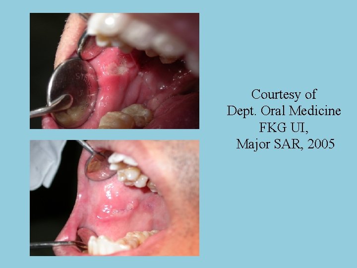 Courtesy of Dept. Oral Medicine FKG UI, Major SAR, 2005 