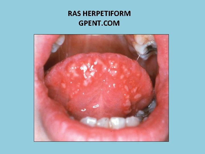 RAS HERPETIFORM GPENT. COM 