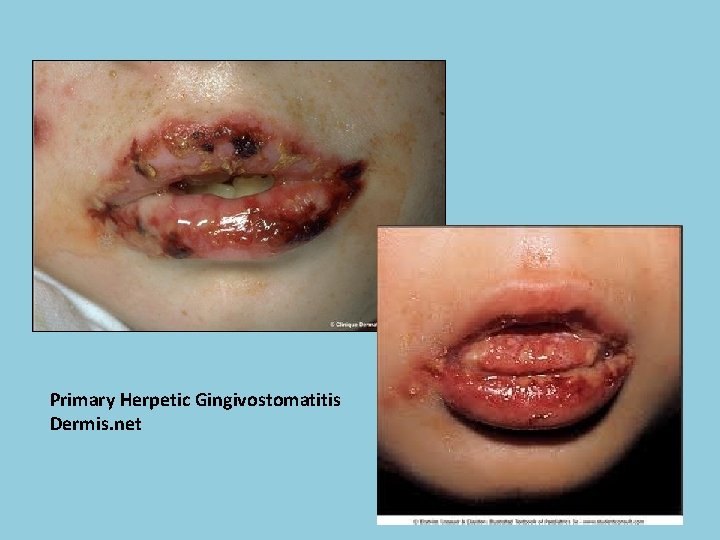 Primary Herpetic Gingivostomatitis Dermis. net 