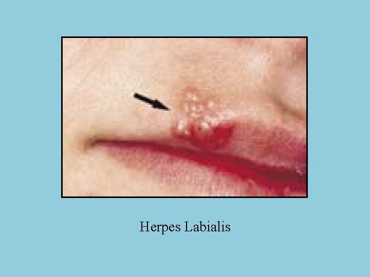 Herpes Labialis 