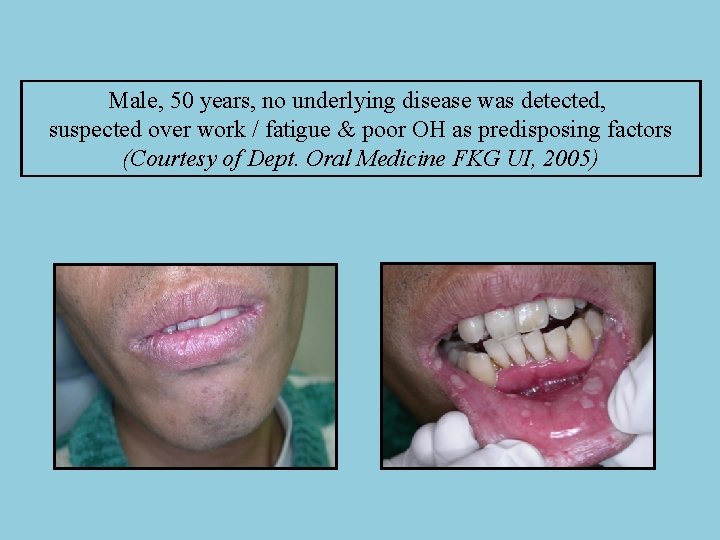 Male, 50 years, no underlying disease was detected, suspected over work / fatigue &