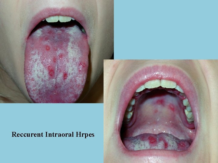 Reccurent Intraoral Hrpes 