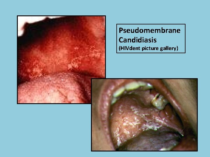 Pseudomembrane Candidiasis (HIVdent picture gallery) 