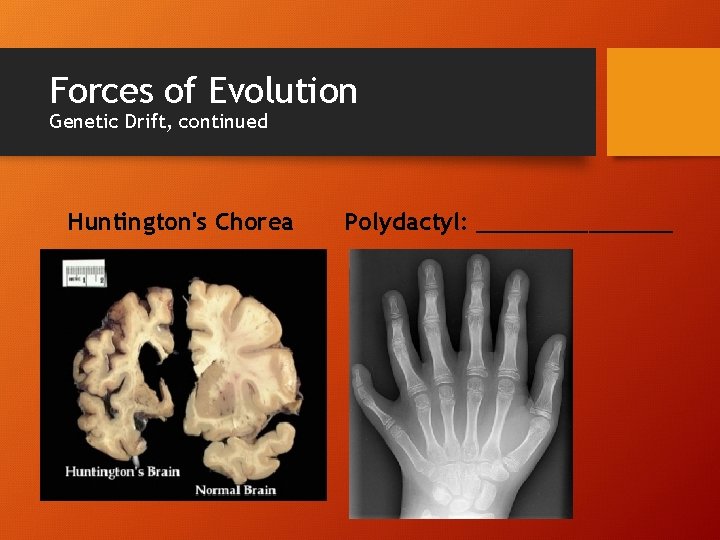 Forces of Evolution Genetic Drift, continued Huntington's Chorea Polydactyl: _______ 