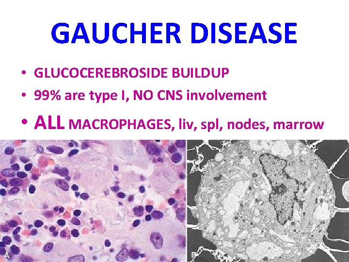 GAUCHER DISEASE • GLUCOCEREBROSIDE BUILDUP • 99% are type I, NO CNS involvement •