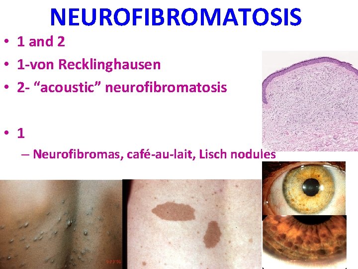 NEUROFIBROMATOSIS • 1 and 2 • 1 -von Recklinghausen • 2 - “acoustic” neurofibromatosis
