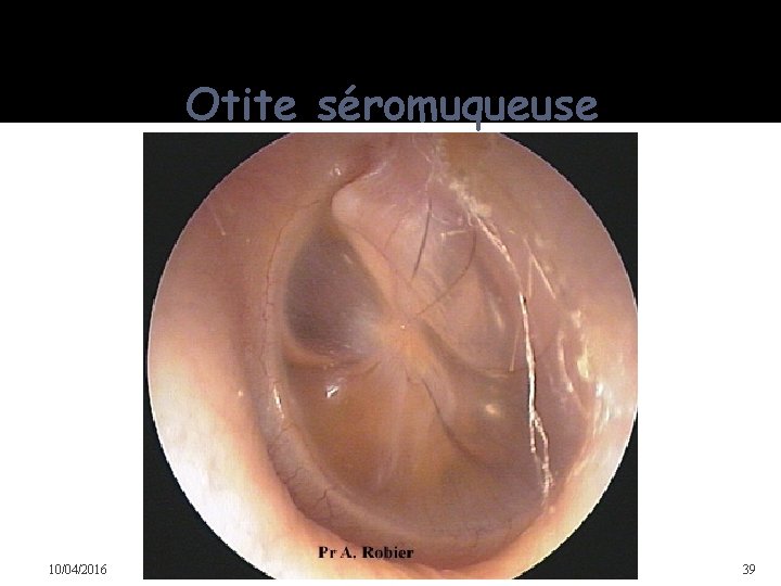 Otite séromuqueuse 10/04/2016 Dr Soussa Dr Abdallah 2ème annee medecine 39 