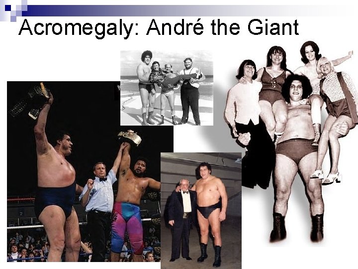 Acromegaly: André the Giant 