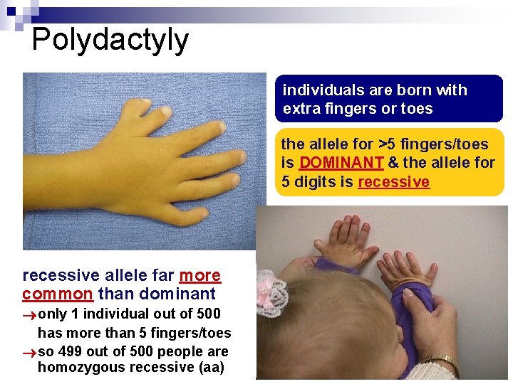 Polydactyly individuals are born with extra fingers or toes the allele for >5 fingers/toes