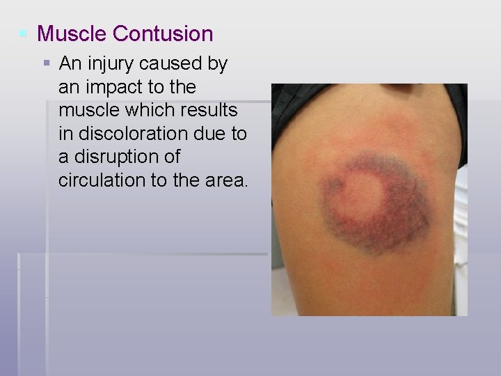 § Muscle Contusion § An injury caused by an impact to the muscle which