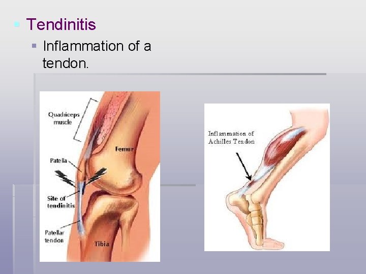 § Tendinitis § Inflammation of a tendon. 