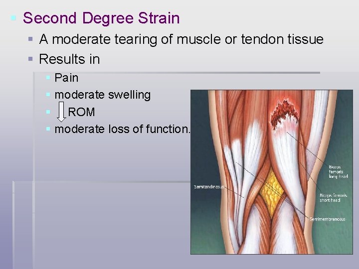 § Second Degree Strain § A moderate tearing of muscle or tendon tissue §