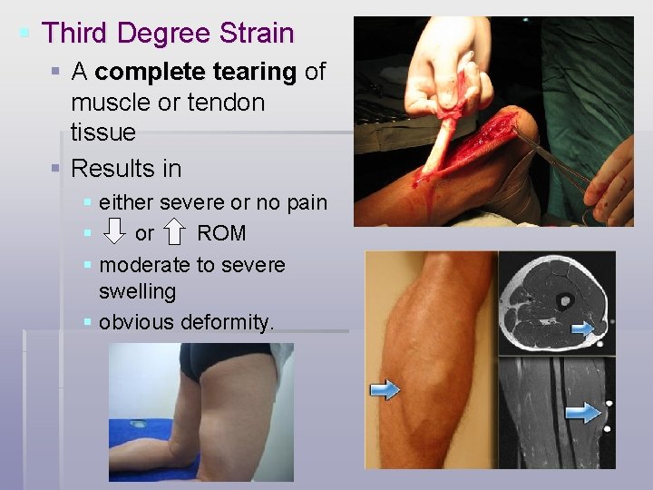 § Third Degree Strain § A complete tearing of muscle or tendon tissue §
