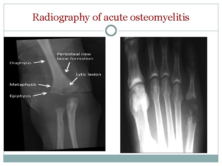Radiography of acute osteomyelitis 