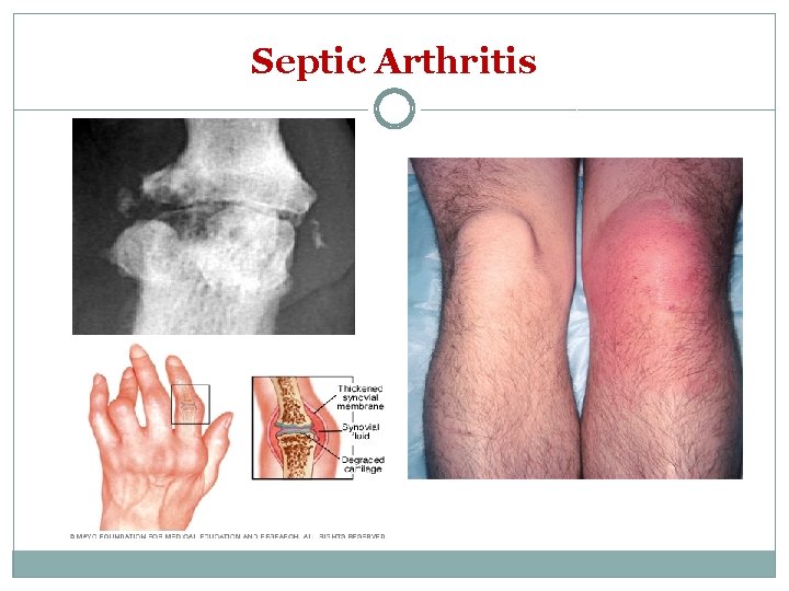 Septic Arthritis 